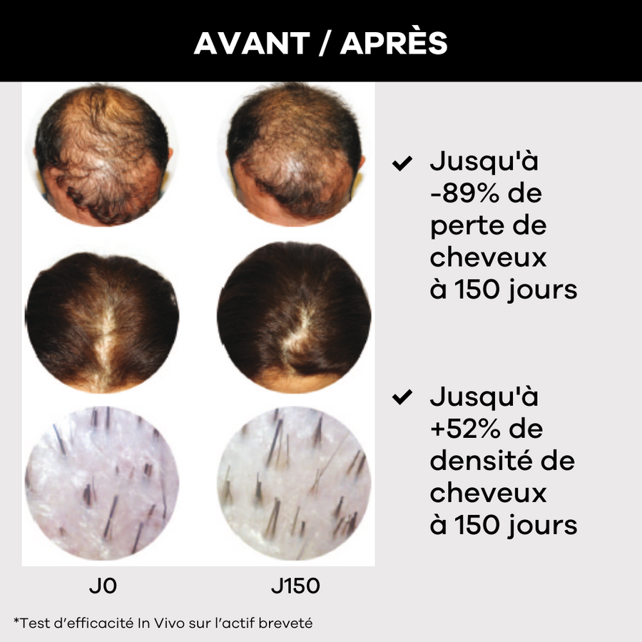  Analyzing image    avant-apres-cheveux-pousse-beaux-cheveux-calvitie